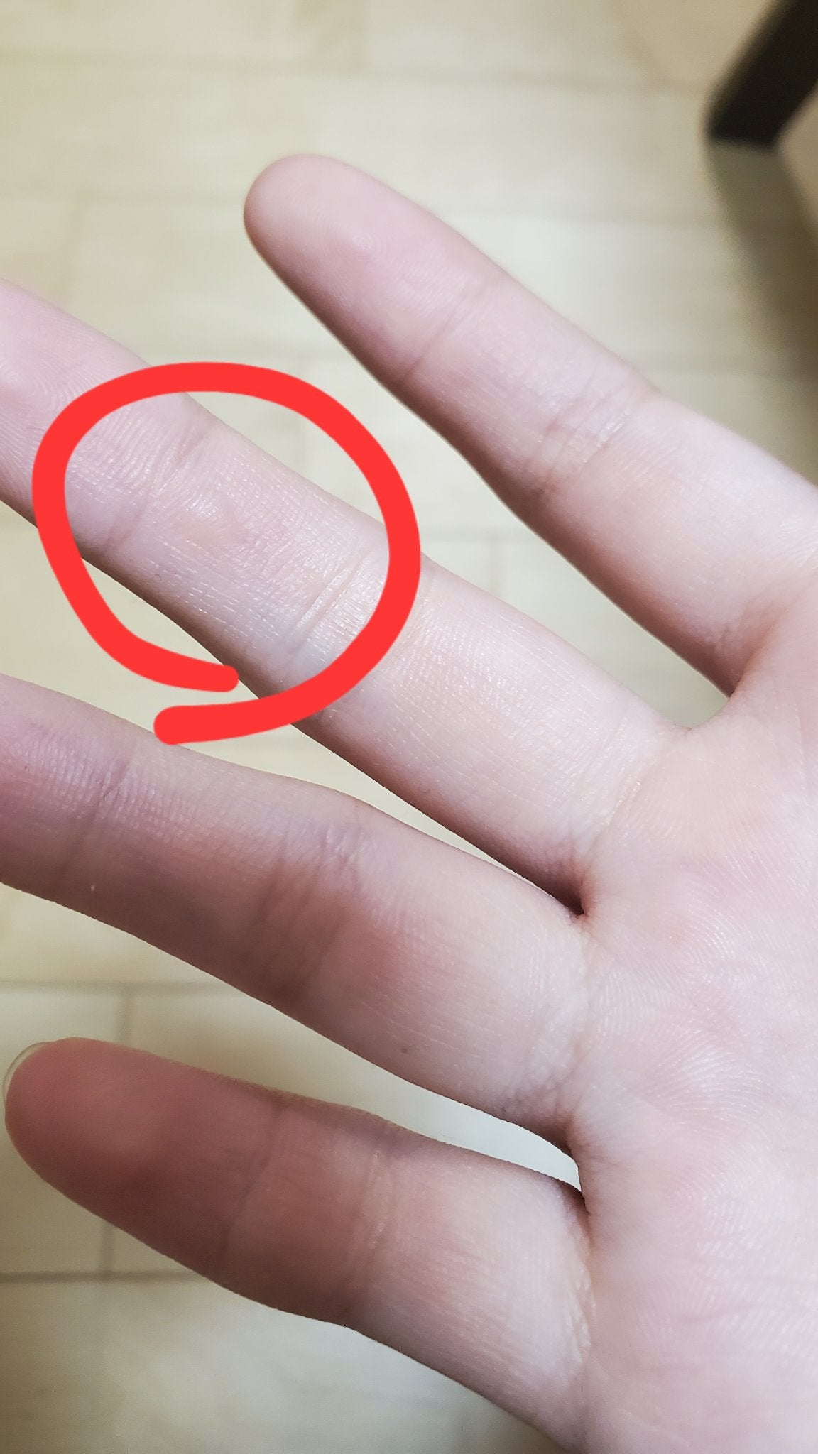 もな | フォロバ100 on LIPS 「水ぶくれ出来ました(´・ω・`)めちゃくちゃ痛い🤕なんでこうな..」(2枚目)