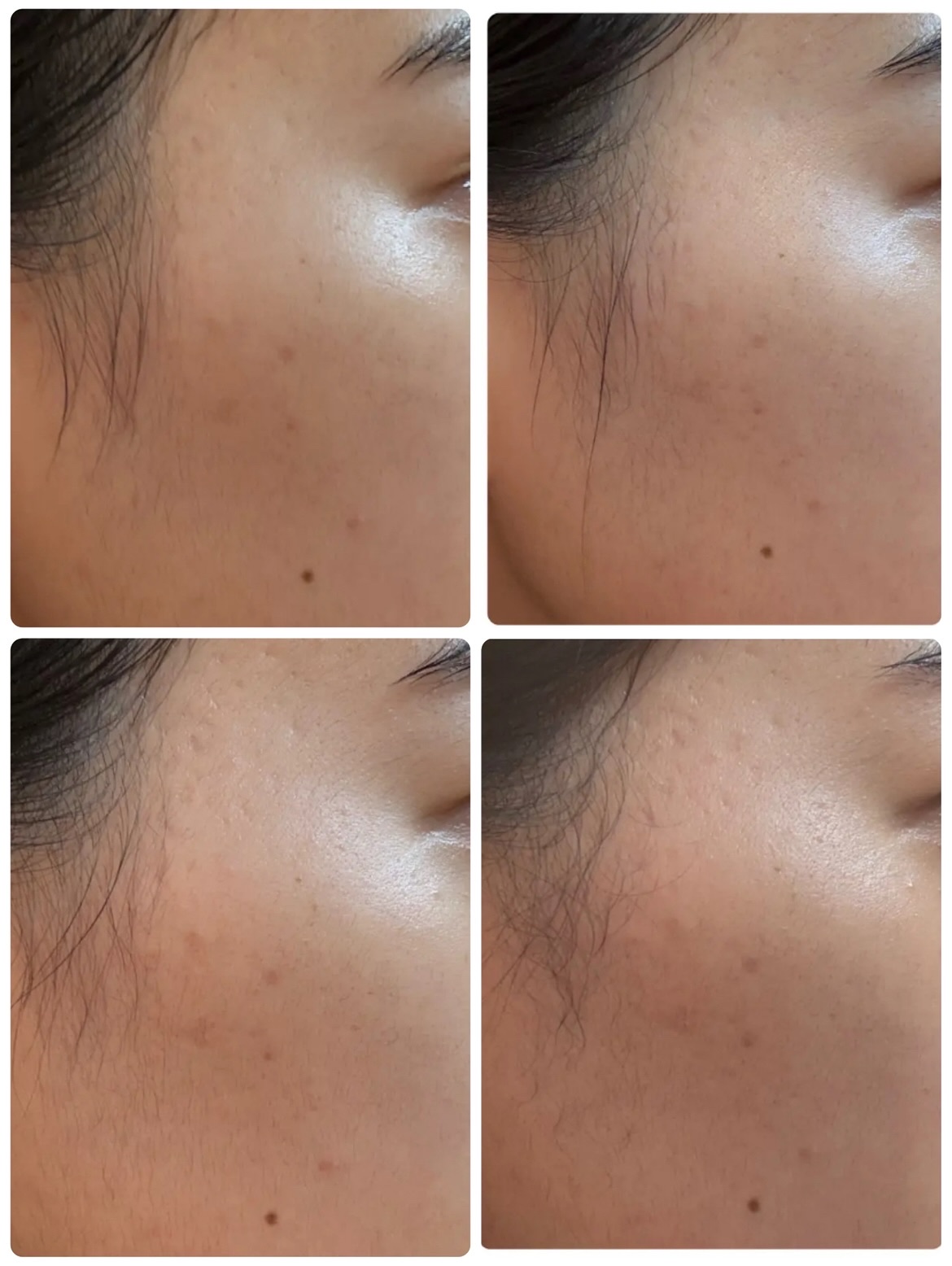 PDRN+リードルS 100/VT/美容液を使ったクチコミ（3枚目）