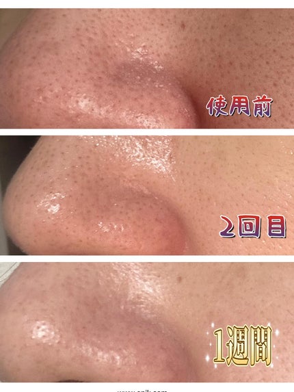 シカレチA エッセンス0.1/VT/美容液を使ったクチコミ(4枚目)