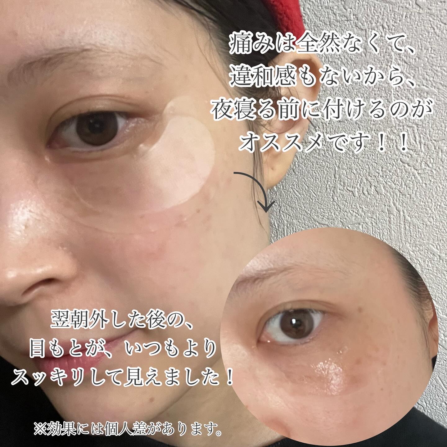 アイバックリフト1100シャットリードルパッチ/CHARDE/シートマスク・パックを使ったクチコミ（3枚目）