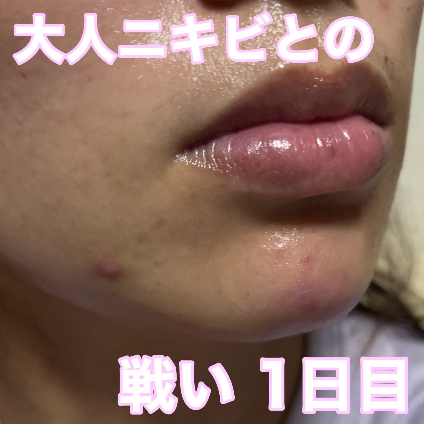 ペアアクネクリームW(医薬品)/ペア/その他を使ったクチコミ（1枚目）