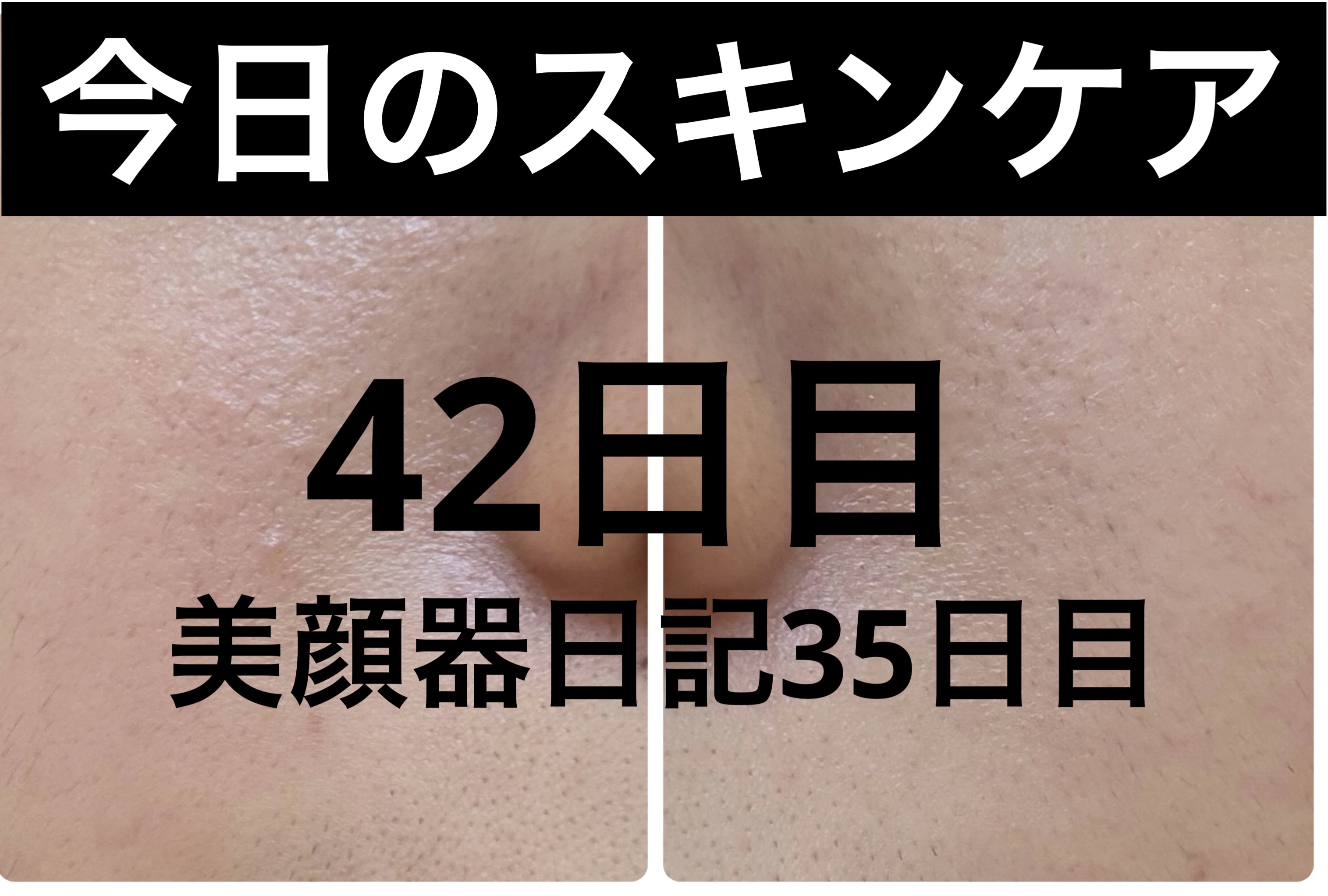 AGE-R ブースタープロ/MEDICUBE/美顔器・マッサージを使ったクチコミ（1枚目）