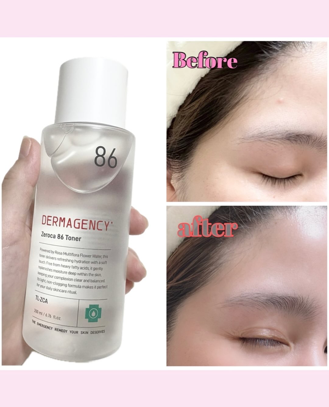 ダーマジェンシー ゼロカ86 トナー/DERMAGENCY/化粧水を使ったクチコミ（2枚目）