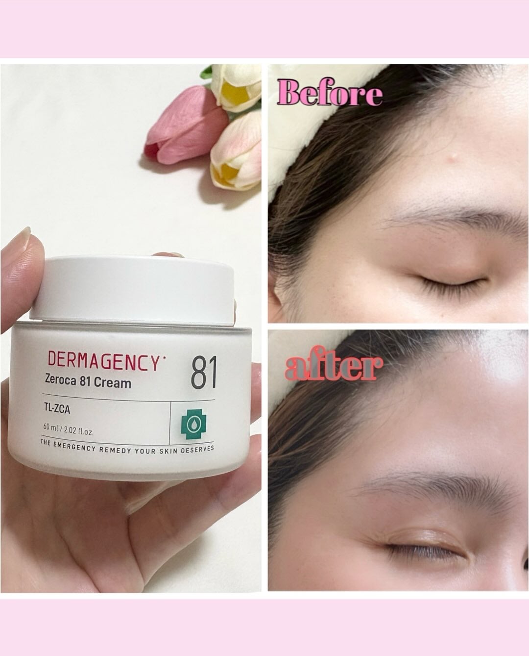 ダーマジェンシー ゼロカ81 クリーム/DERMAGENCY/フェイスクリームを使ったクチコミ(2枚目)