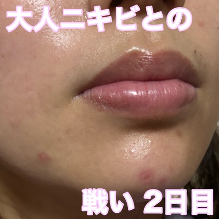 ペアアクネクリームW(医薬品)/ペア/その他を使ったクチコミ(1枚目)