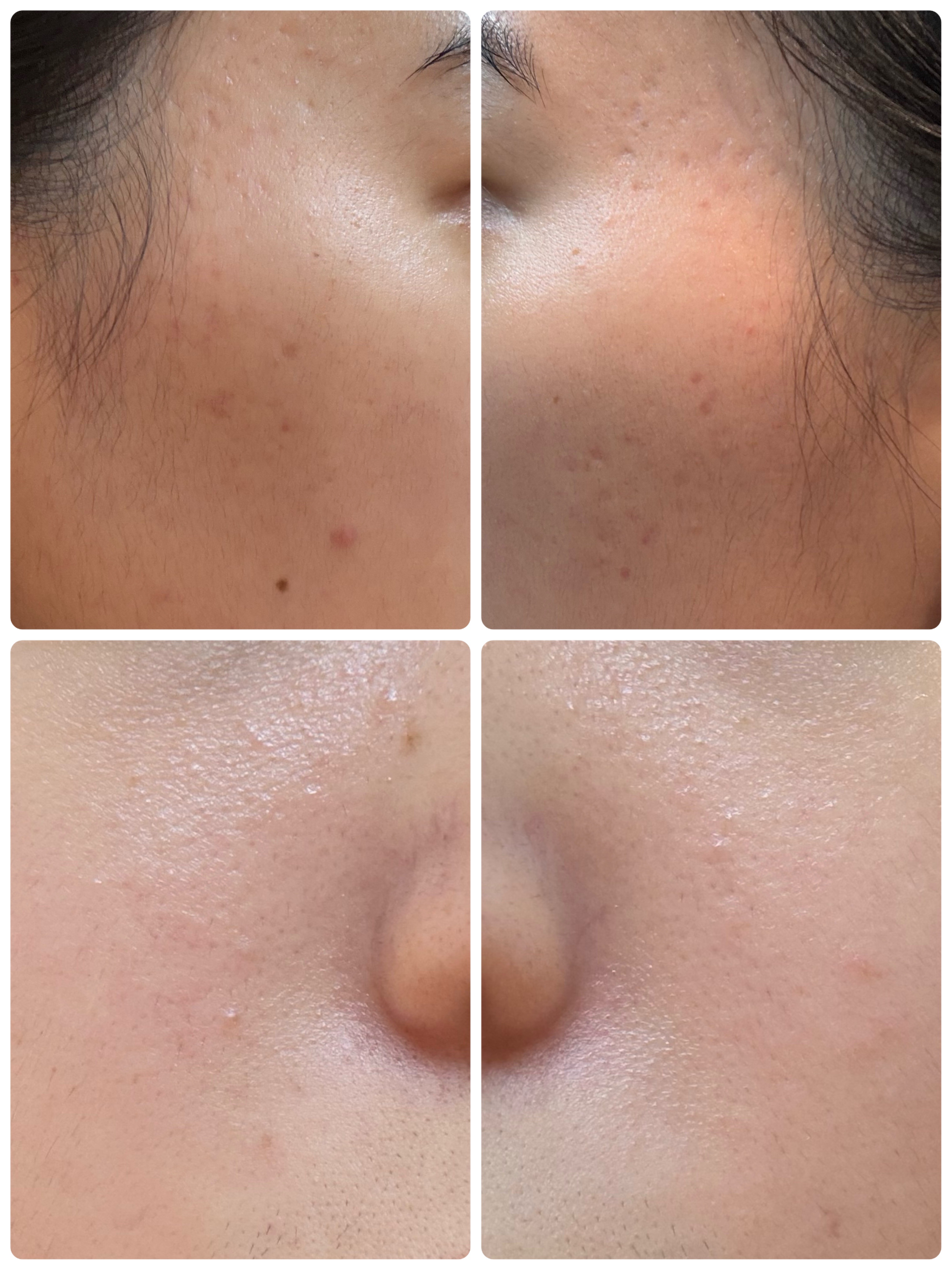 薬用雪肌精 ブライトニング クレンジング オイル[医薬部外品]/雪肌精/オイルクレンジングを使ったクチコミ（2枚目）