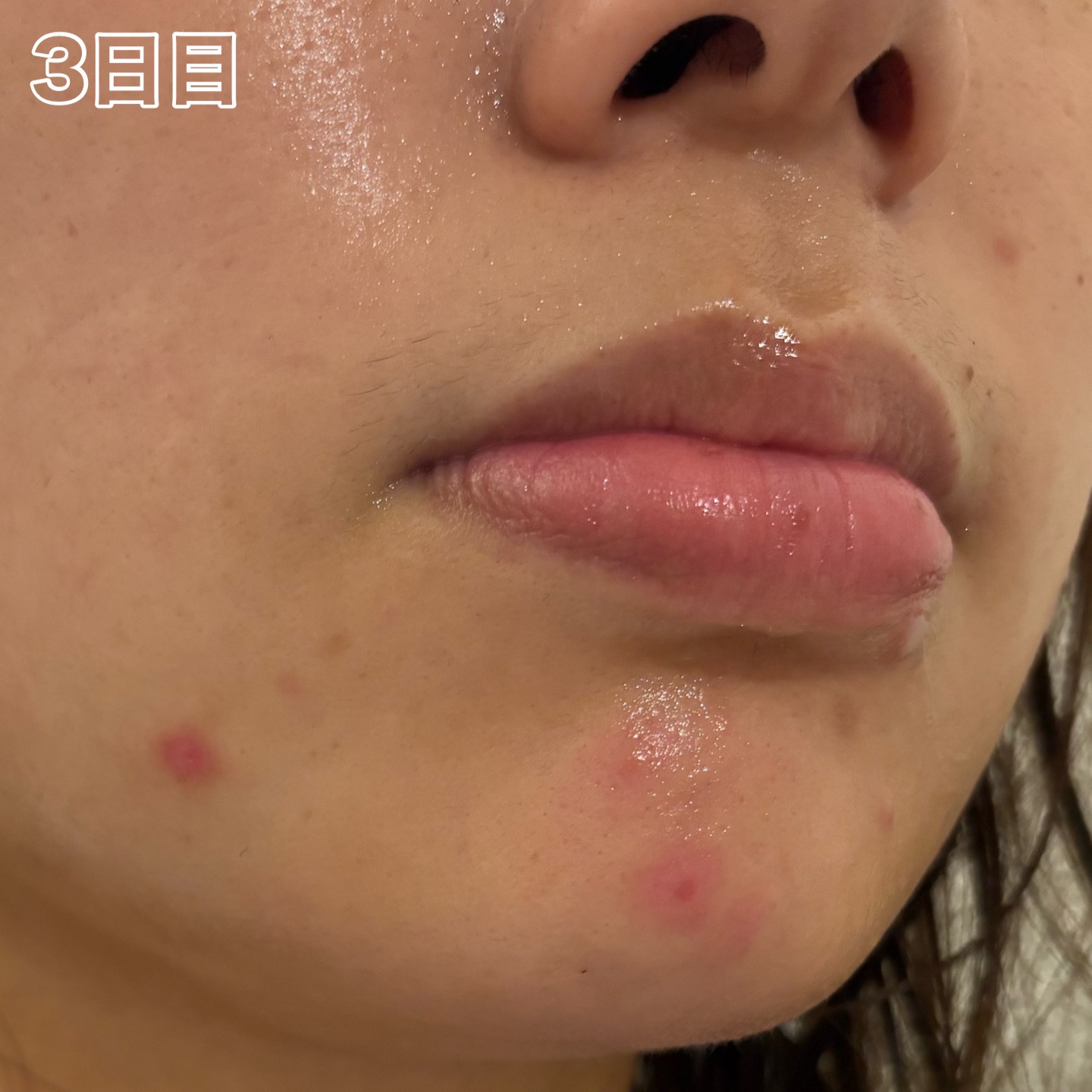 ペアアクネクリームW(医薬品)/ペア/その他を使ったクチコミ（3枚目）