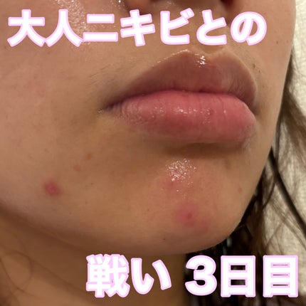 ペアアクネクリームW(医薬品)/ペア/その他を使ったクチコミ(1枚目)