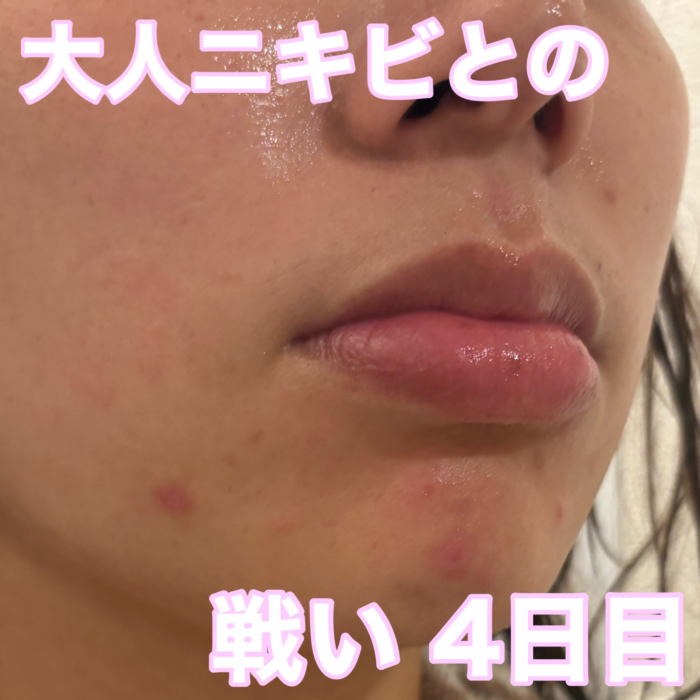 ペアアクネクリームW(医薬品)/ペア/その他を使ったクチコミ（1枚目）