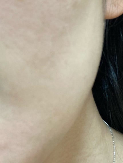 C×AZ ダーマインショット200/ESIENCE/美容液を使ったクチコミ(6枚目)