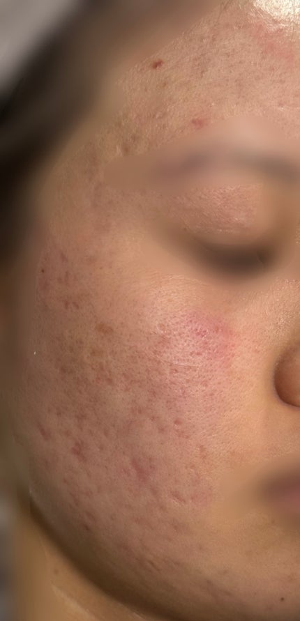 トリア・スキン エイジングケアレーザー/トリア/美顔器・マッサージを使ったクチコミ(1枚目)