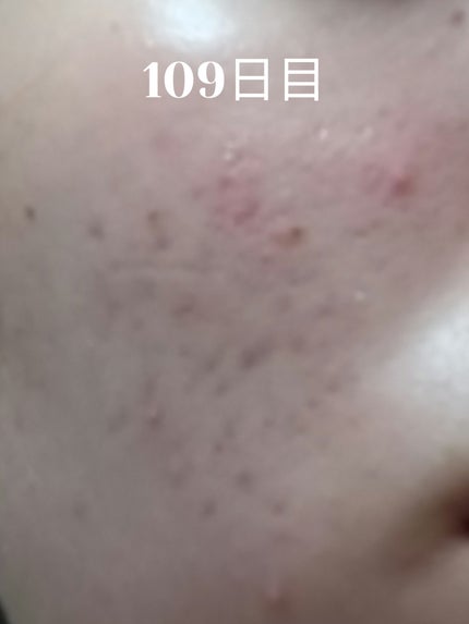 いぬ✢フォロバ100✢ on LIPS 「自分用ニキビ記録109日目新しいニキビでき始めてる…赤みも復活..」(1枚目)