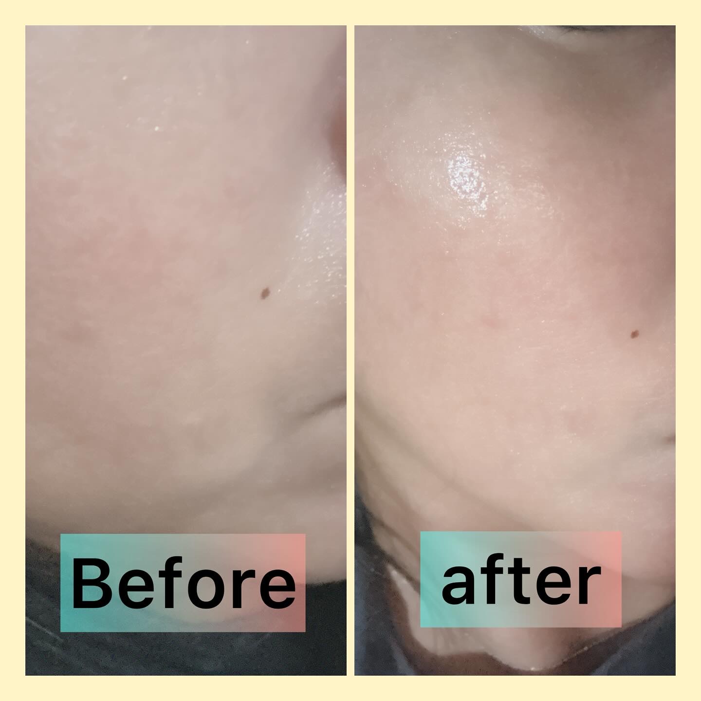 C×AZ ダーマインショット200/ESIENCE/美容液を使ったクチコミ（3枚目）