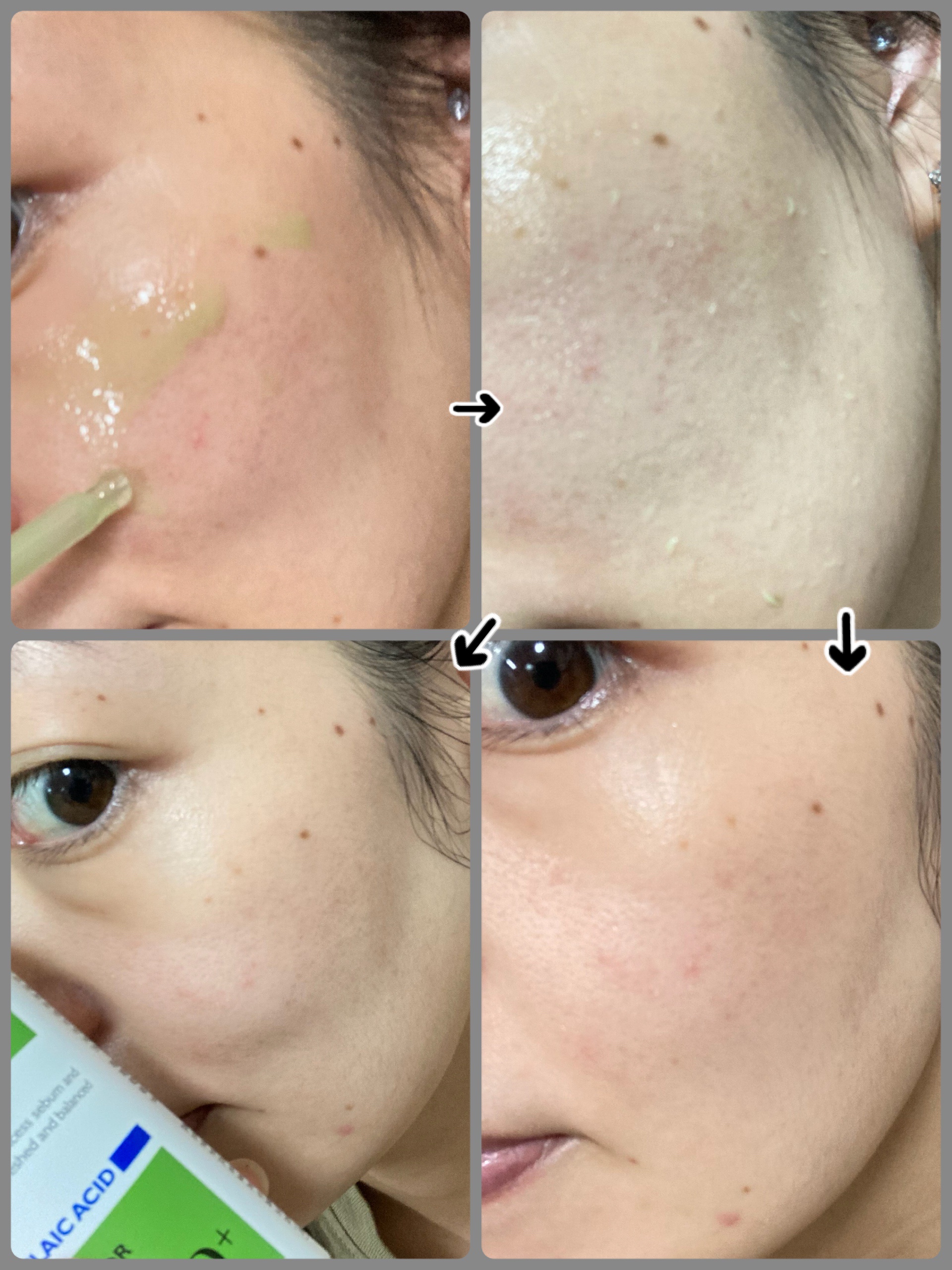 アゼライン酸ゴマージュピーリングセラム/Dr.Melaxin/美容液を使ったクチコミ（2枚目）