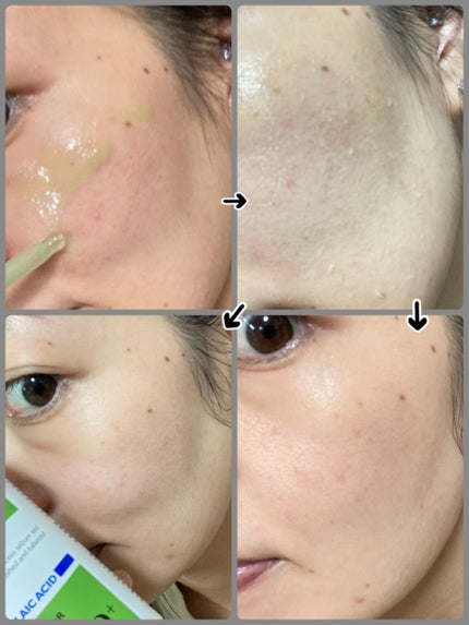 アゼライン酸ゴマージュピーリングセラム/Dr.Melaxin/美容液を使ったクチコミ(2枚目)