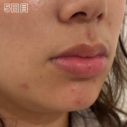 ペアアクネクリームW(医薬品)/ペア/その他を使ったクチコミ(3枚目)