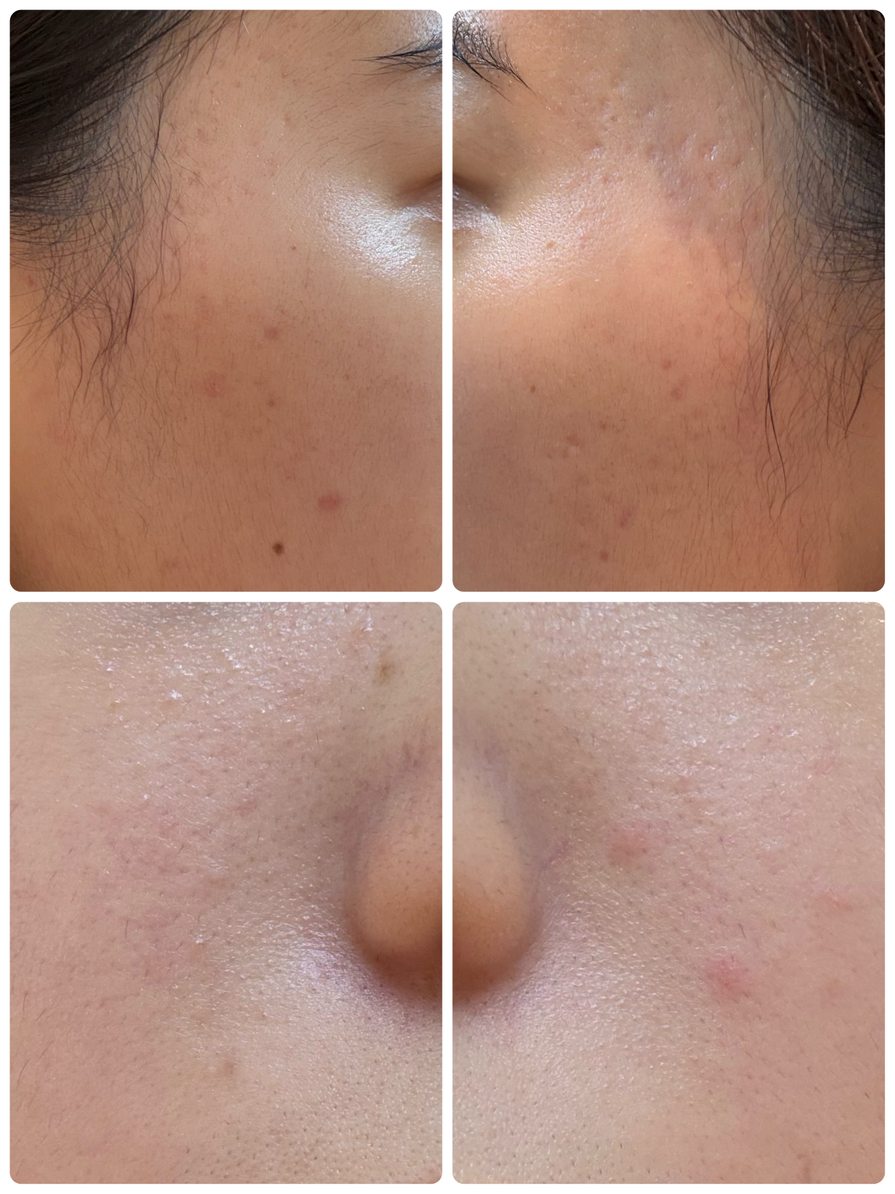 ブラックヘッドバームスクラブ/オブジェ/フェイスバームを使ったクチコミ（2枚目）