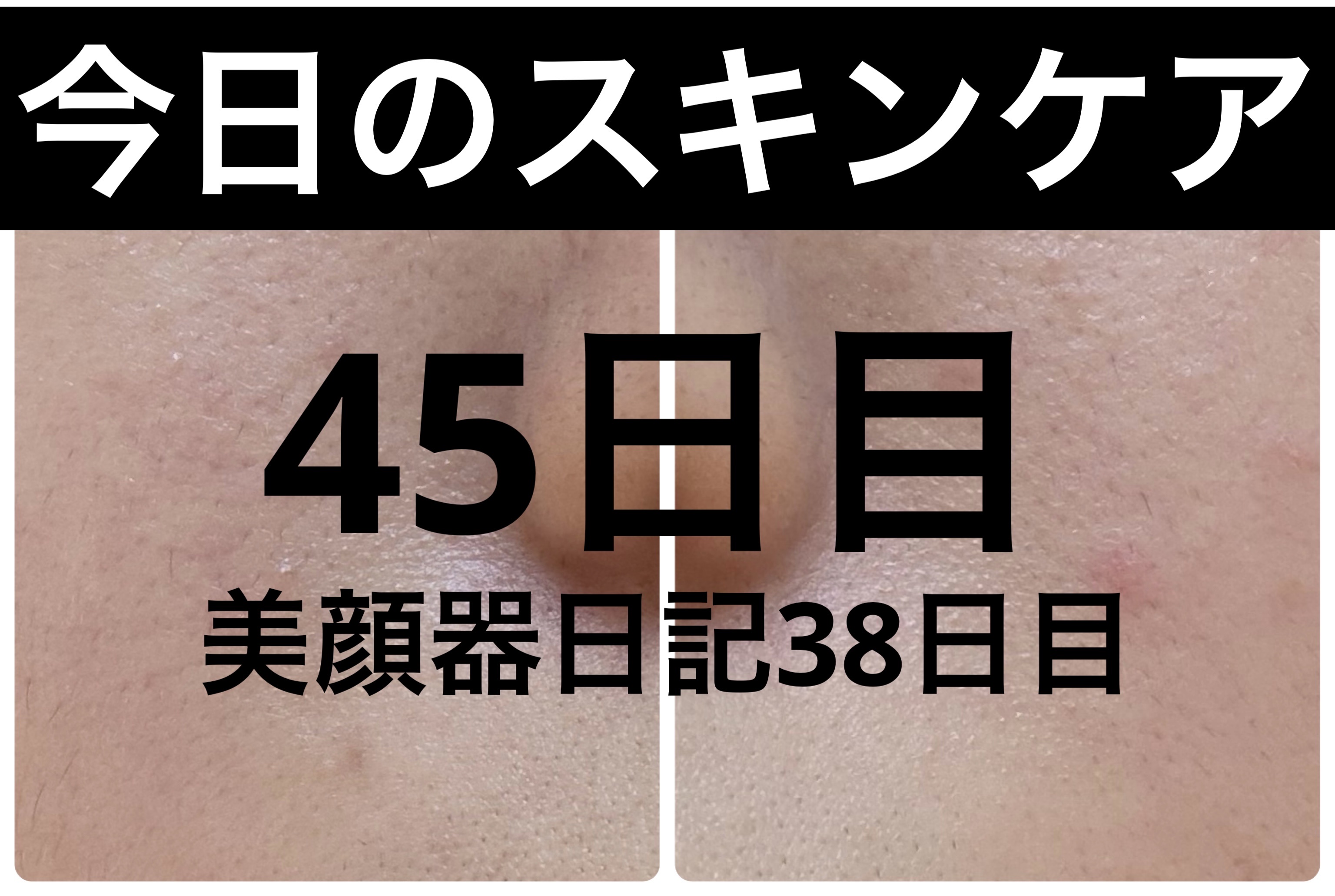 ブラックヘッドバームスクラブ/オブジェ/フェイスバームを使ったクチコミ（1枚目）