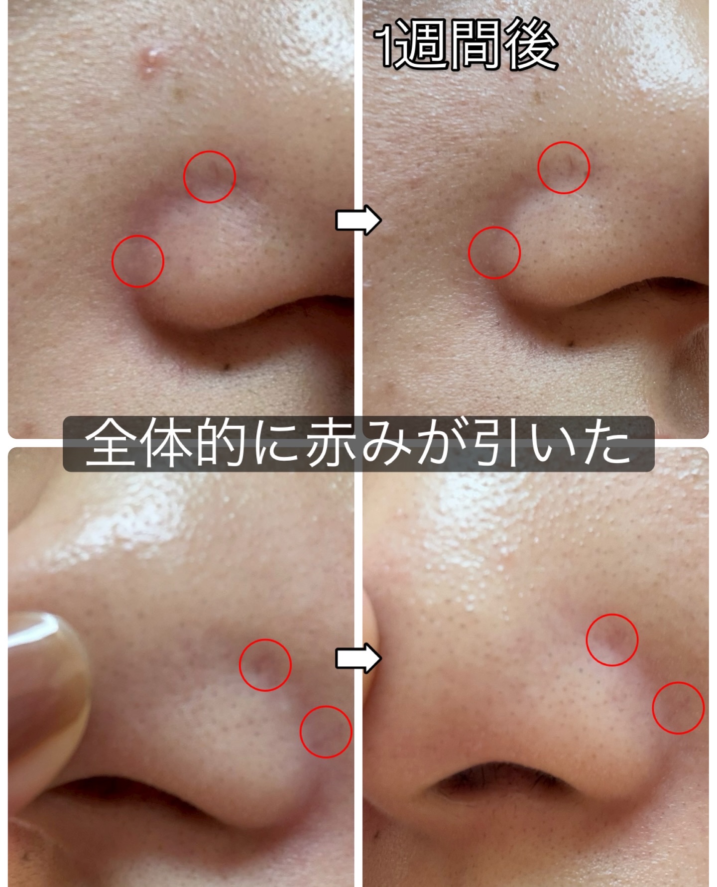 ブラックヘッドバームスクラブ/オブジェ/フェイスバームを使ったクチコミ（3枚目）