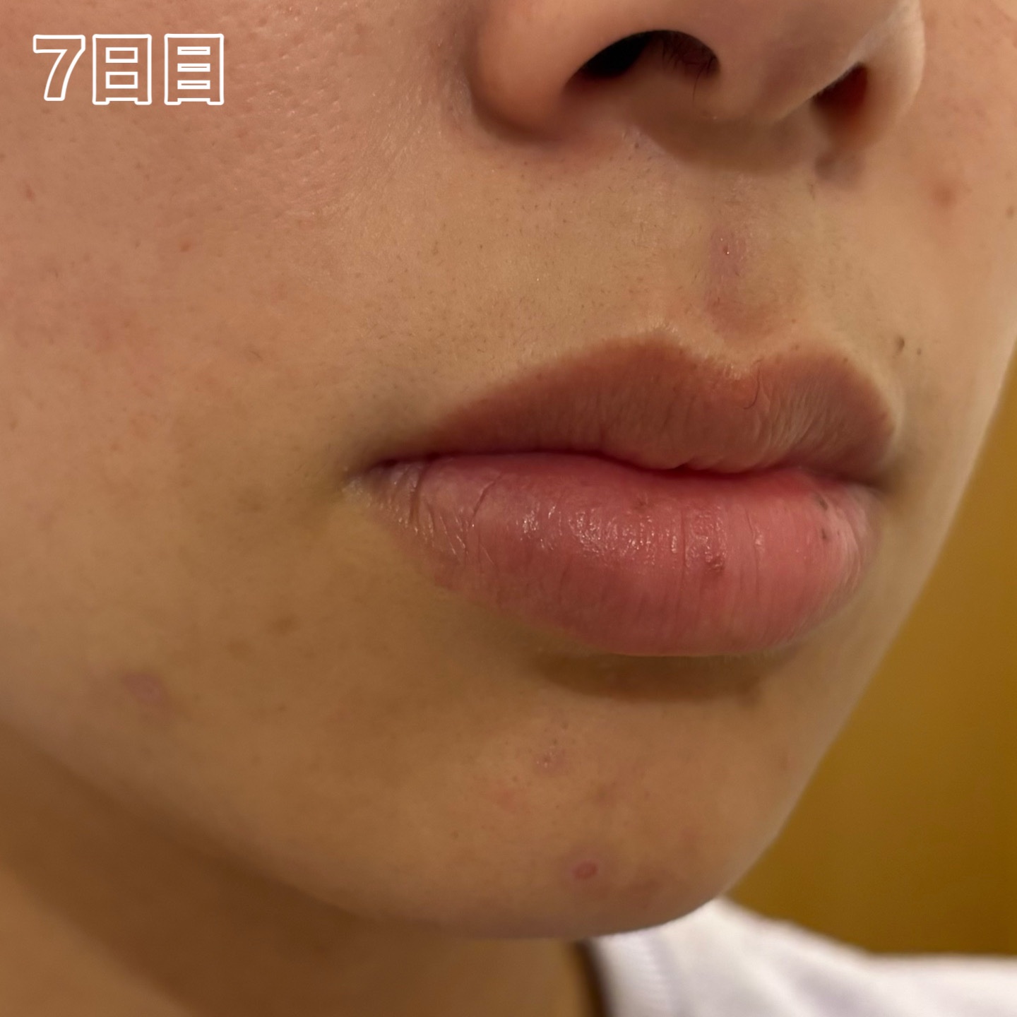 ペアアクネクリームW(医薬品)/ペア/その他を使ったクチコミ（3枚目）