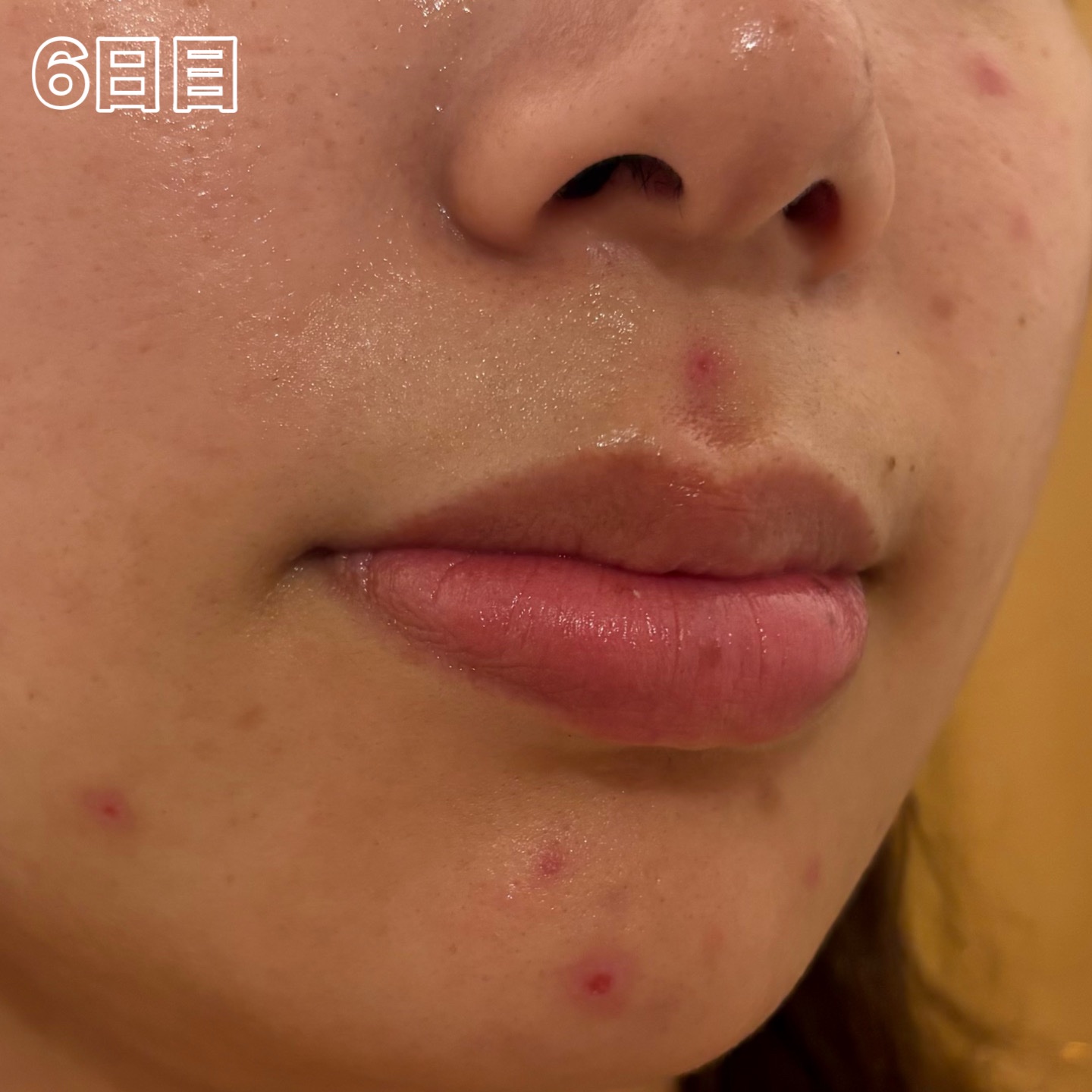 ペアアクネクリームW(医薬品)/ペア/その他を使ったクチコミ（2枚目）