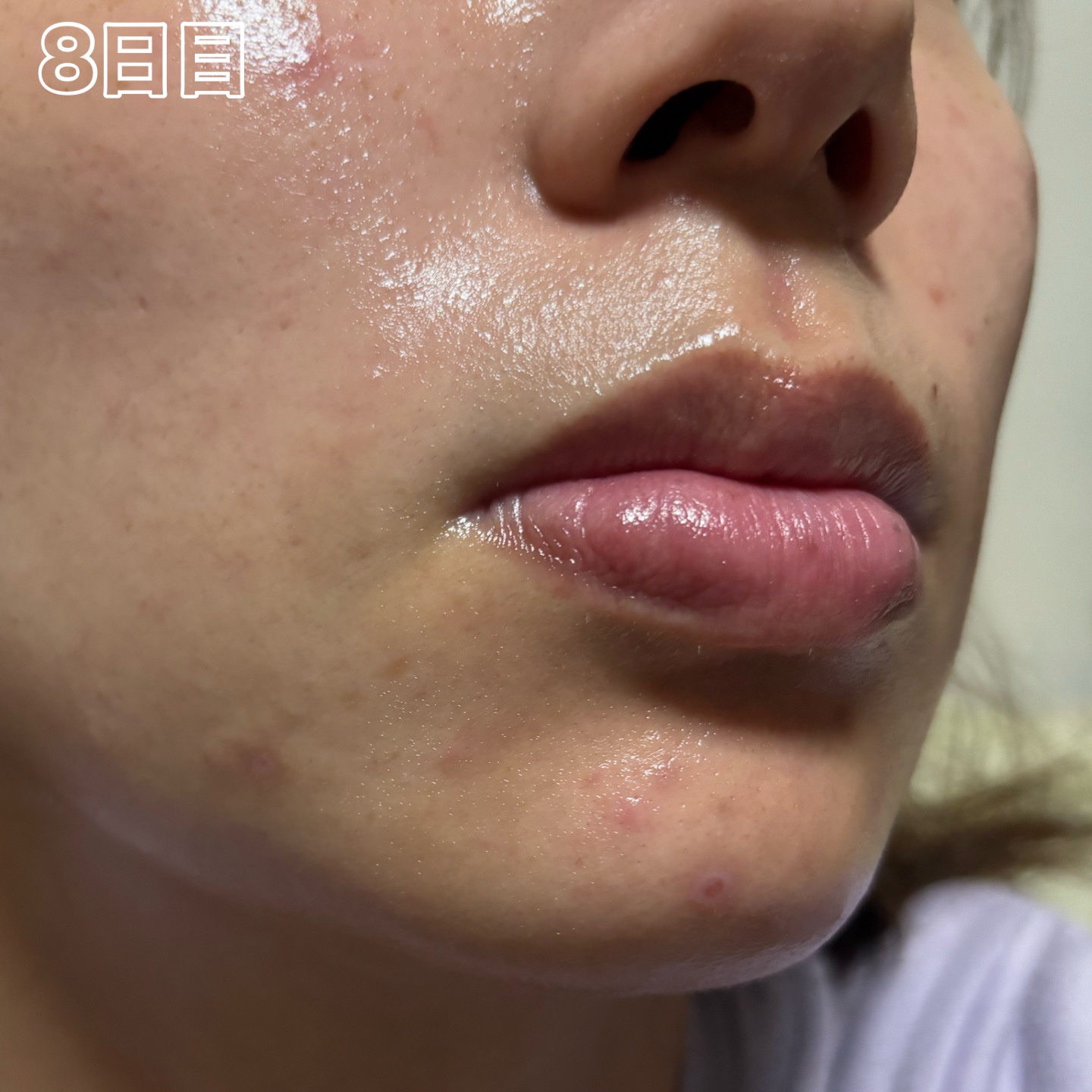 ペアアクネクリームW(医薬品)/ペア/その他を使ったクチコミ（3枚目）