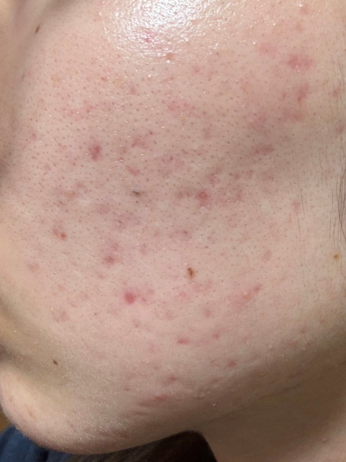 ニキビあとケアジェル/アットノン/その他スキンケアを使ったクチコミ(2枚目)