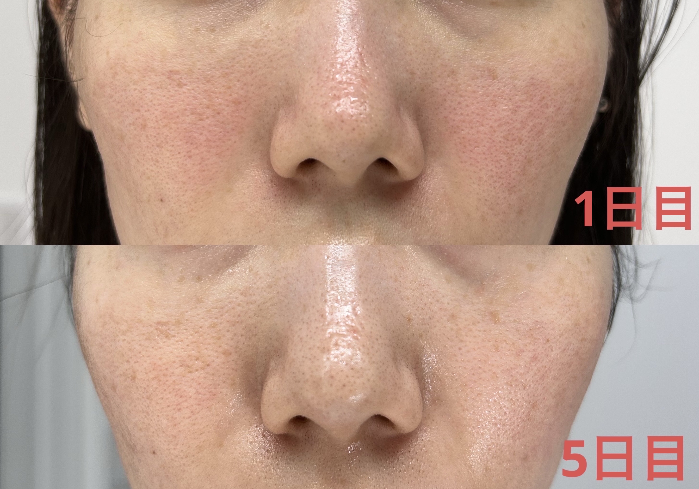 BOTANICAL PEEL Level7 ボタニカルピールLv7 4箱セット BOTANICAL PEEL Level7 ボタニカルピールLv7 4箱セット 楽天市場