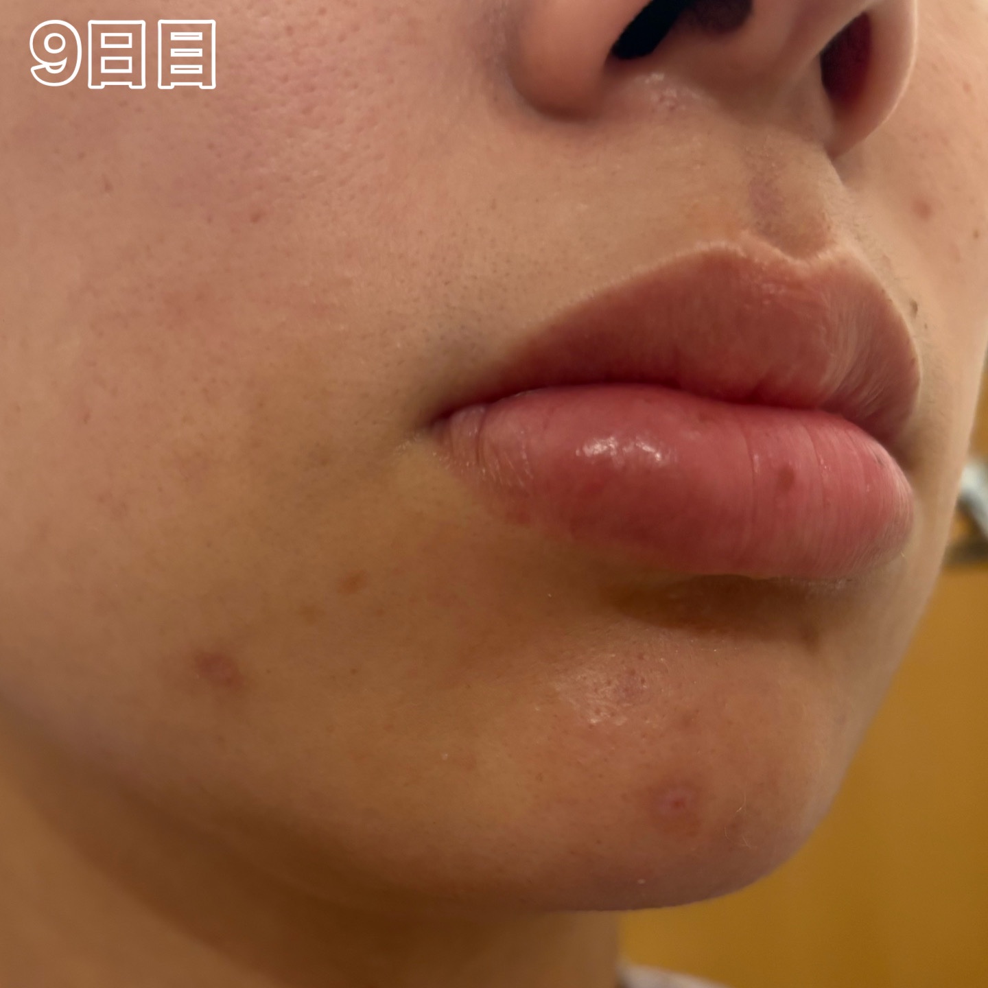 ペアアクネクリームW(医薬品)/ペア/その他を使ったクチコミ（3枚目）