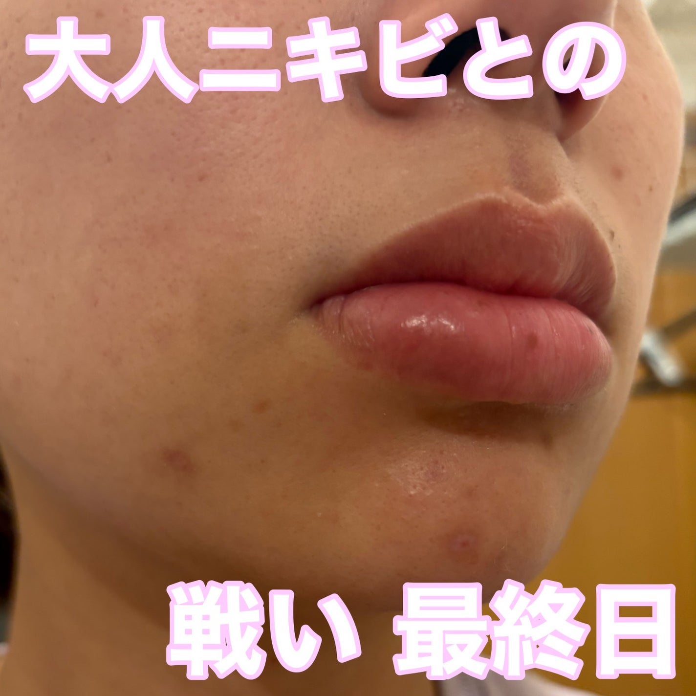 ペアアクネクリームW(医薬品)/ペア/その他を使ったクチコミ(1枚目)