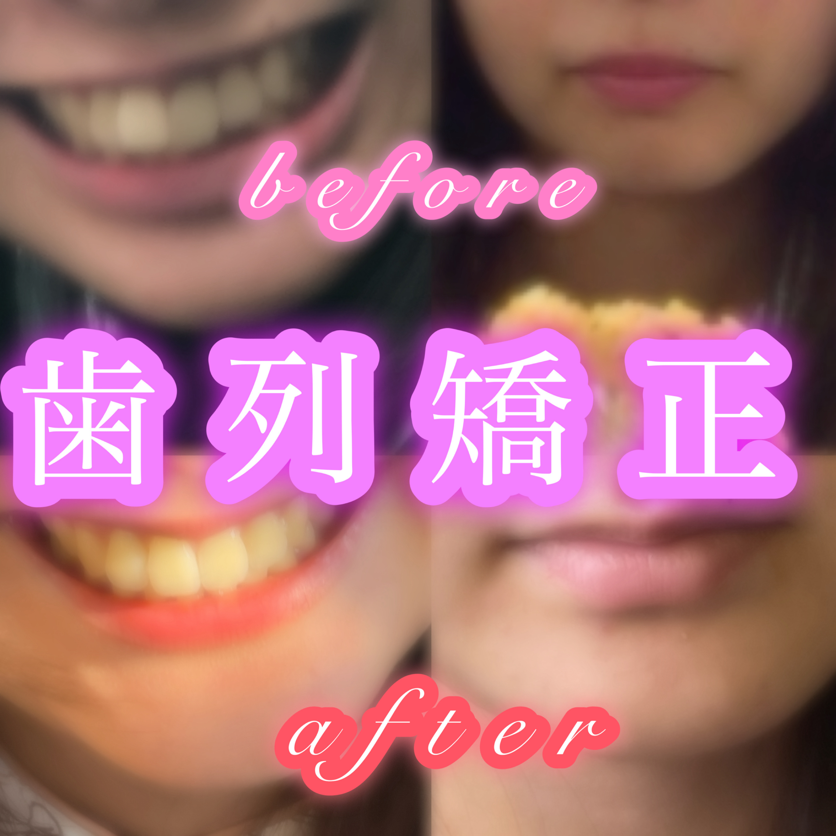 個人的に1番印象が変わる歯列矯正について投稿します！

私自身矯正でめちゃくちゃ印象が変わったから、もし検討してる方がいたら参考になれば幸いです😳

①痛みについて
ほぼ毎月、器具の調整が必要で調整後はかなり痛い😭😭😭お粥しか食べら