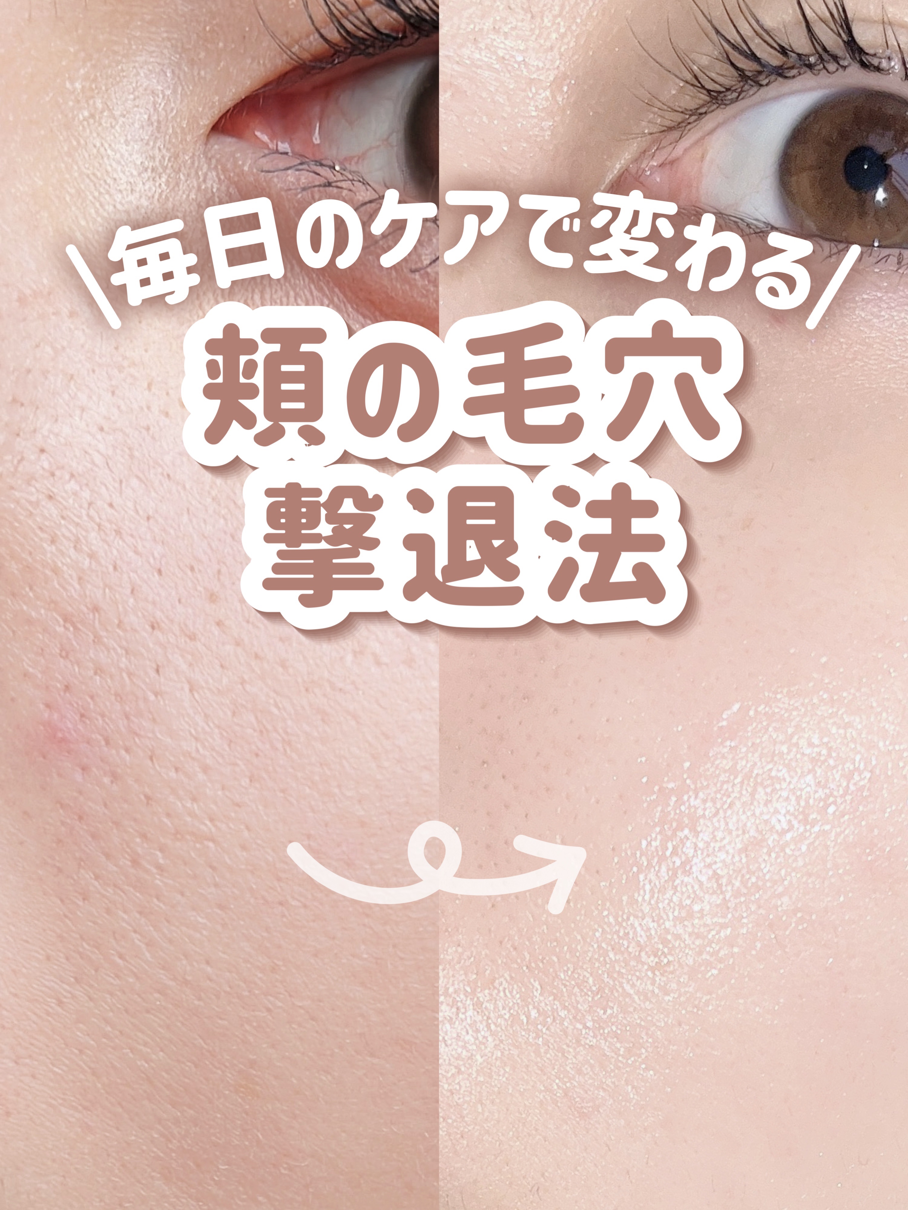 ＼毛穴レスな赤ちゃん肌に／
頬の毛穴撃退法👶🏻‪‪‎🤍

- - - - - - - - - - - - - - - - - - - - - - - - - -

ファンデいらずの毛穴レス肌になれる、毎日の毛穴ケア方法を紹介します！�