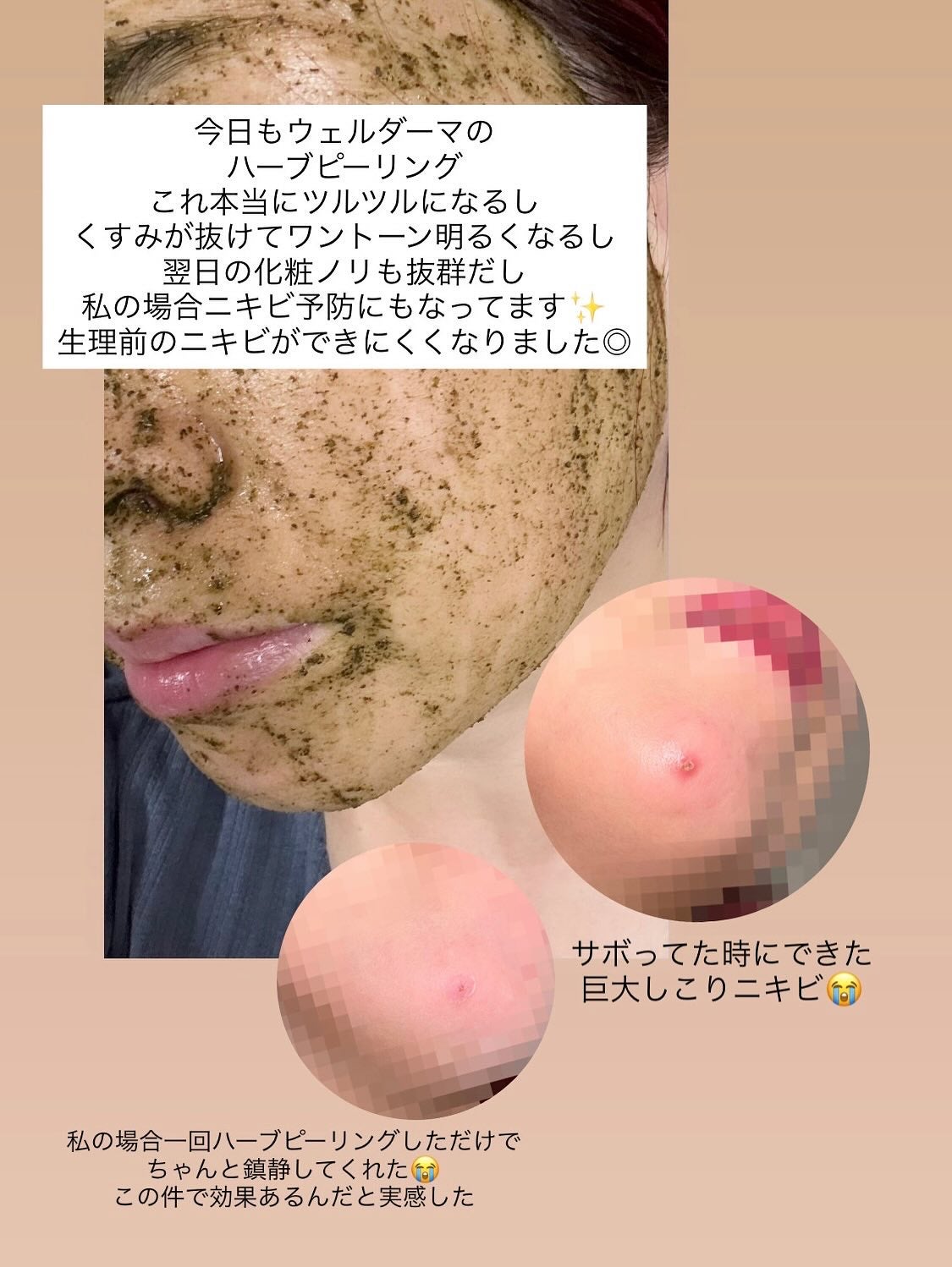 ティーツリーハーブピーリングパック/WellDerma/洗い流すパック・マスクを使ったクチコミ(2枚目)