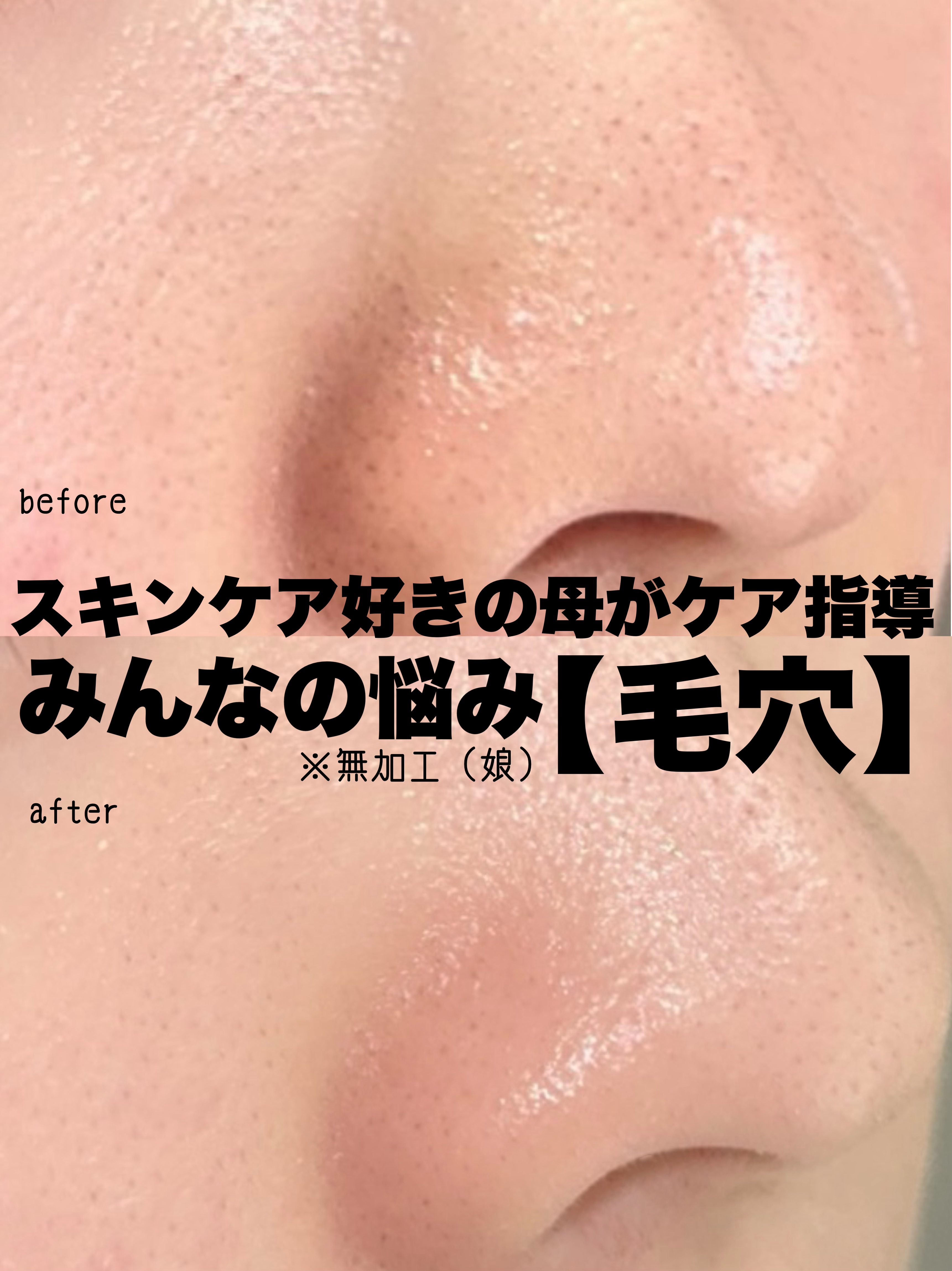 薬用クリア化粧水/メンソレータム アクネス/化粧水を使ったクチコミ（1枚目）