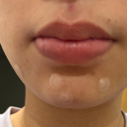 プロCICA クリアスポットパッチ/VT/その他スキンケアを使ったクチコミ(5枚目)