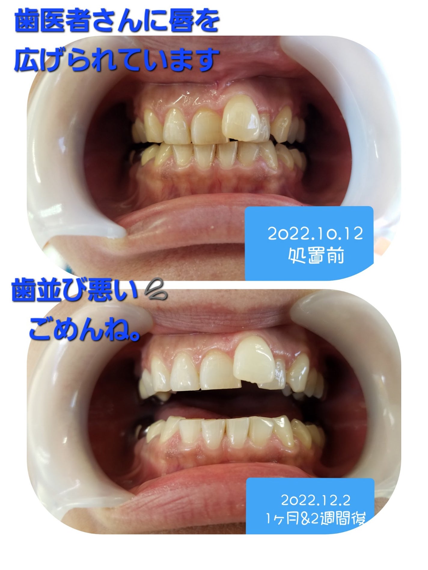 Shima on LIPS 「∕歯医者さんのホワイトニング(((^^;)✨∕歯のアップ、「1..」(2枚目)