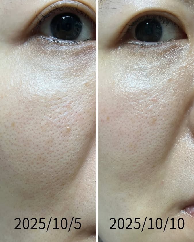 【記録用】

保湿クリームと朝晩パックに加え、
洗顔を酵素洗顔に変えてみたのが、
こちらの写真になります。

どうでしょうか5日間でこの変化はなかなか良いような気もしてます。

でもなかなか毛穴の開きが閉じない。
これは加齢のせいなのでしょ