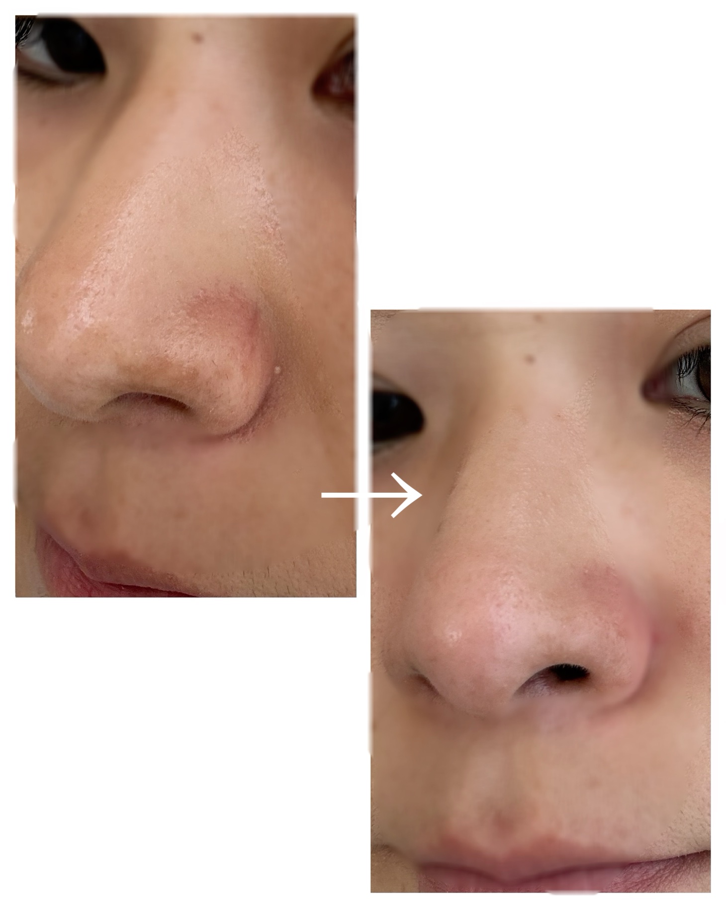 ILSO　スーパーメルティング セバムソフトナー/ilso/化粧水を使ったクチコミ（3枚目）