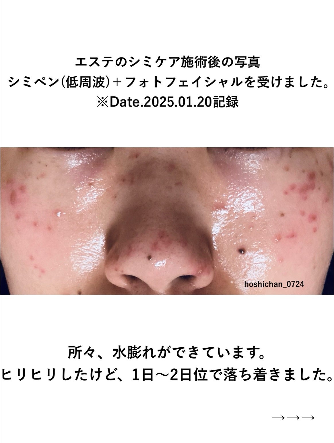 ほし⭐︎フォロバします♪(元美容部員) on LIPS 「#シミケアエステ#美肌への道📓シミケア記録〜皮膚トラブル編〜※..」(3枚目)