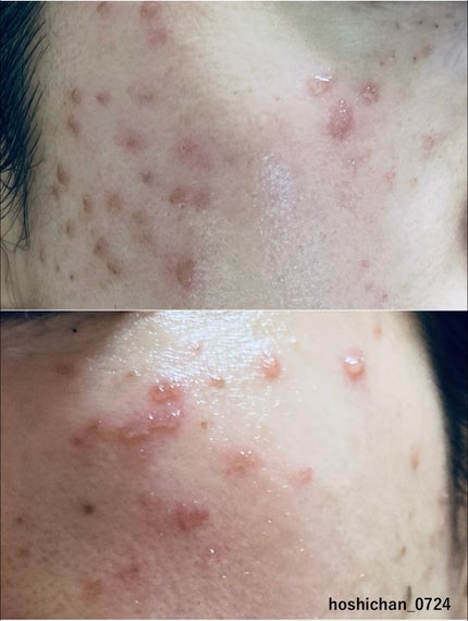 ほし⭐︎フォロバします♪(元美容部員) on LIPS 「#シミケアエステ#美肌への道📓シミケア記録〜皮膚トラブル編〜※..」(4枚目)