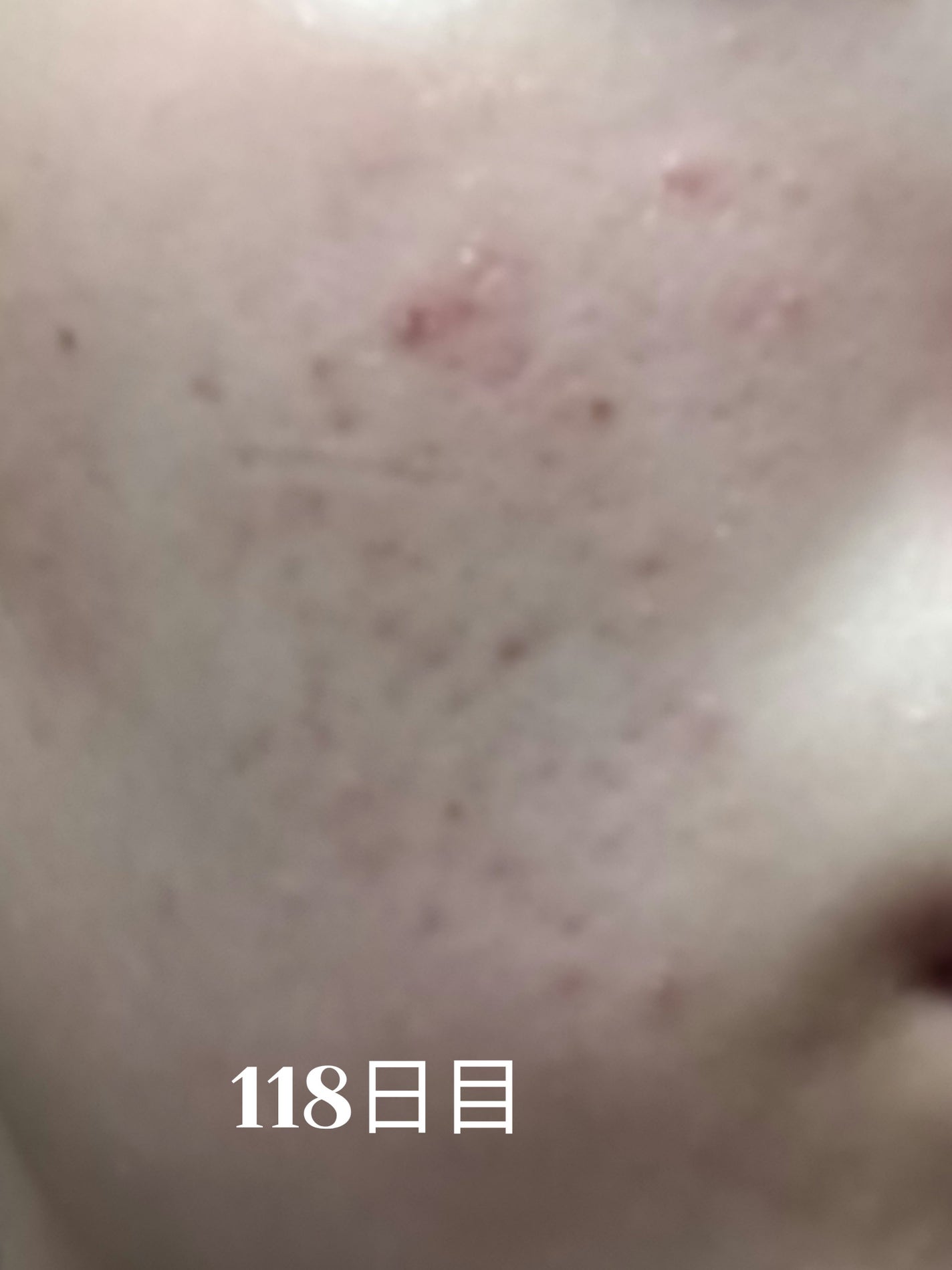 いぬ✢フォロバ100✢ on LIPS 「自分用ニキビ記録118日目良くなってるはず!寝る時間が不規則に..」(1枚目)