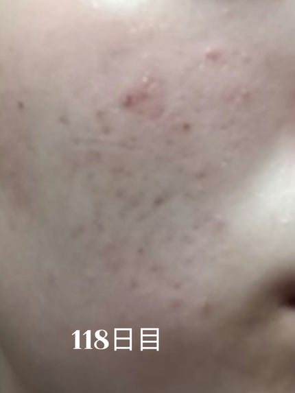 いぬ✢フォロバ100✢ on LIPS 「自分用ニキビ記録118日目良くなってるはず!寝る時間が不規則に..」(1枚目)