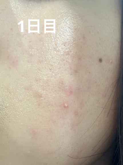 S100 リードル/VT/美容液を使ったクチコミ(5枚目)