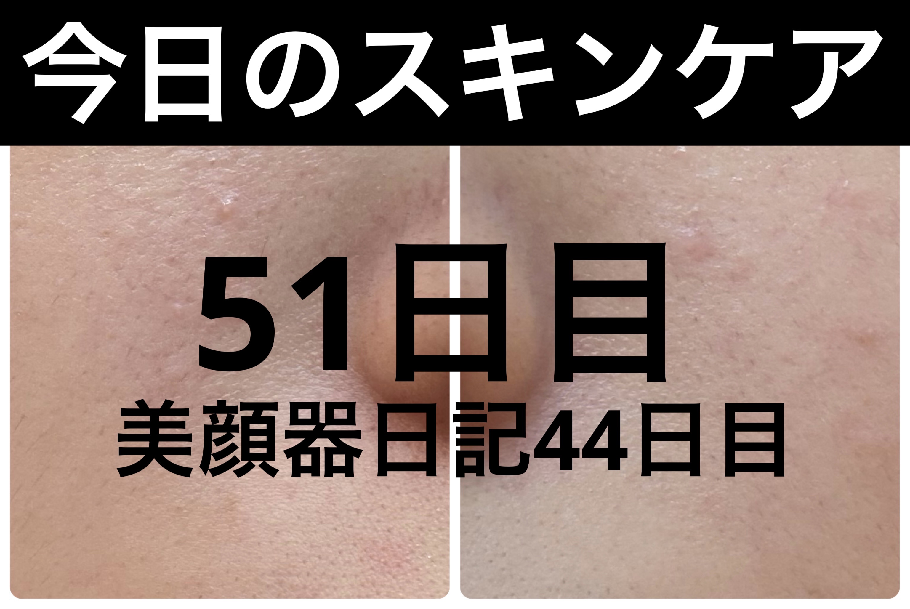 薬用雪肌精 ブライトニング クレンジング オイル[医薬部外品]/雪肌精/オイルクレンジングを使ったクチコミ（1枚目）