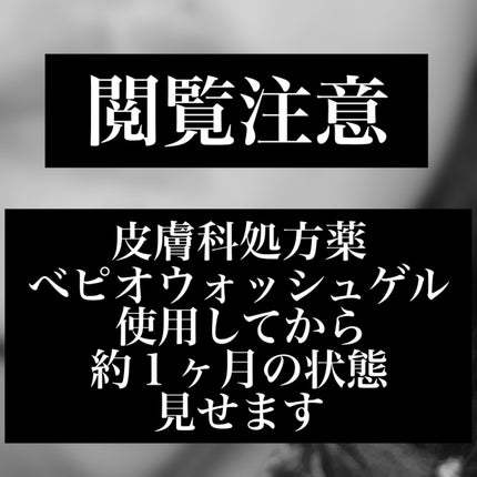 ナナへの気持ち on LIPS 「【皮膚科治療薬】処方された最新薬「べピオウォッシュゲル」を使用..」(1枚目)
