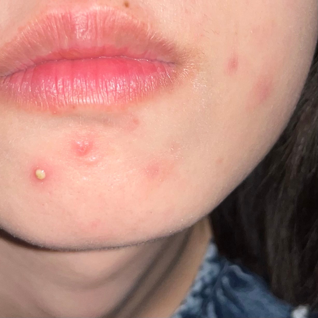 ナナへの気持ち on LIPS 「【皮膚科治療薬】処方された最新薬「べピオウォッシュゲル」を使用..」(2枚目)