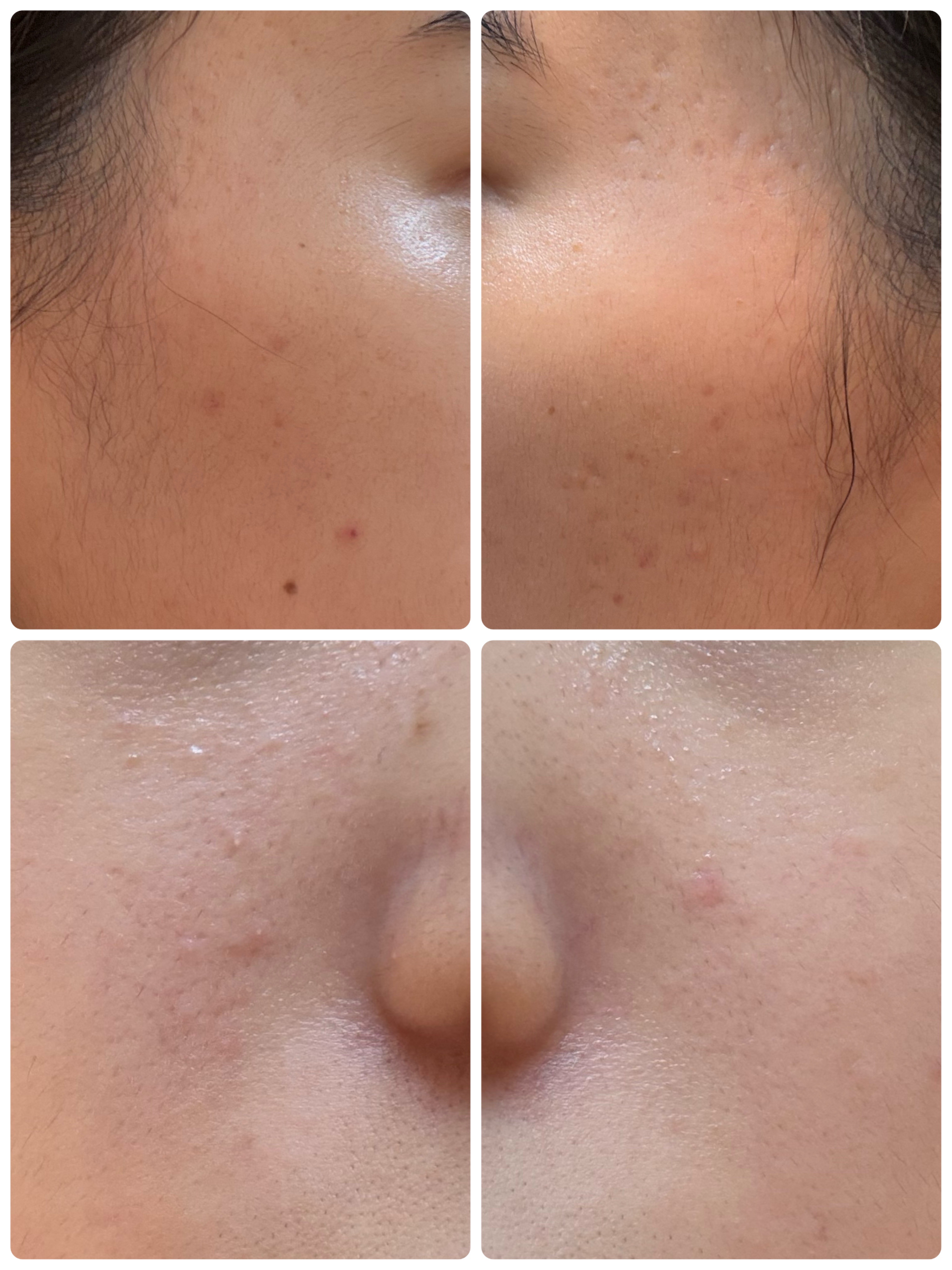 薬用雪肌精 ブライトニング クレンジング オイル[医薬部外品]/雪肌精/オイルクレンジングを使ったクチコミ（2枚目）