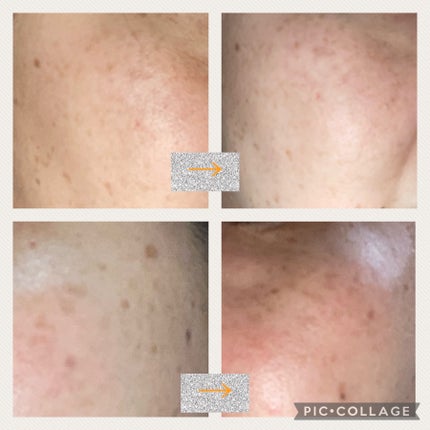 リポピールセラム/LIPOPEEL/美容液を使ったクチコミ(2枚目)