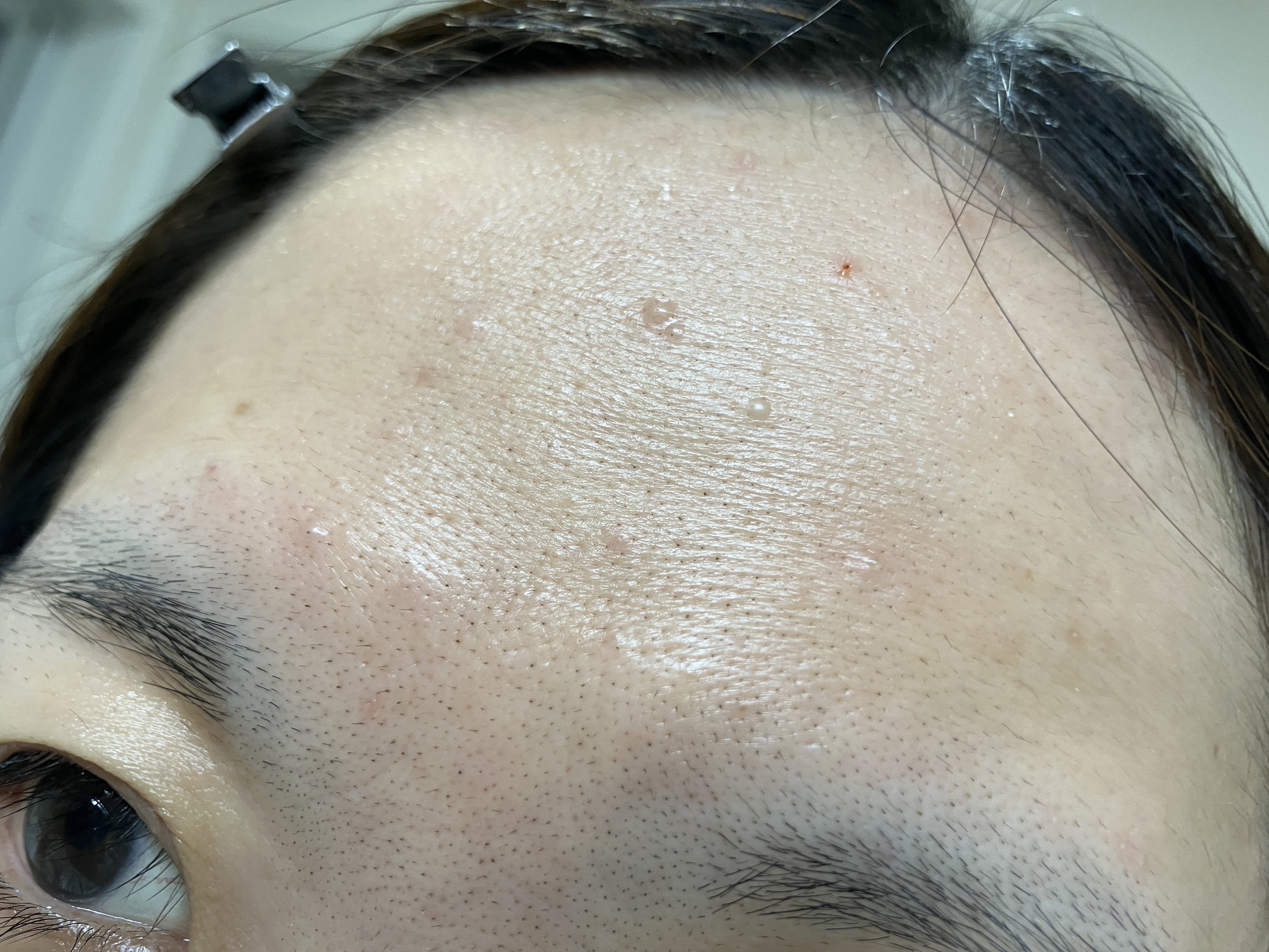 皮膚科行ってきました！
この真ん中にある少し赤い大きい子は粉瘤で

小さい子は、稗粒腫との事
で小さい子は、薬で治して
大きい子は、来週手術で取る事が決まりました！！

早くにやって欲しかったから、
仕事の合間にやってもらう事にしたけど、
