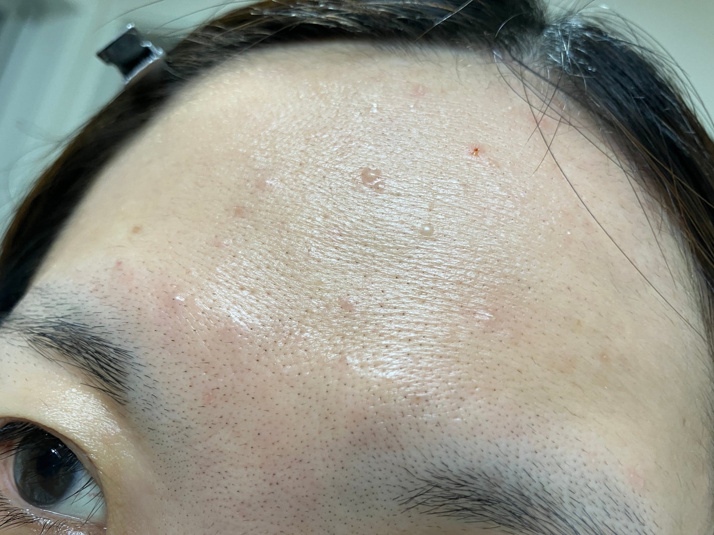 ぼぶ on LIPS 「皮膚科行ってきました!この真ん中にある少し赤い大きい子は粉瘤で..」(1枚目)